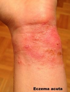 eczema pe picioarele varicozei