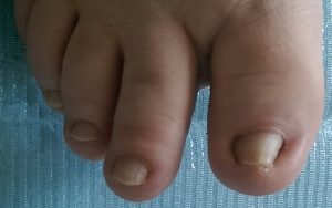 ciuperca înfricoșătoare a unghiilor de la picioare